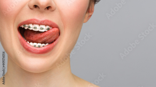 Orthodontic treatment. Closeup ceramic and metal brackets on teeth. Female smile with braces. Dental care concept. photo