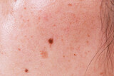 Problems with oily skin with freckles and dark spots