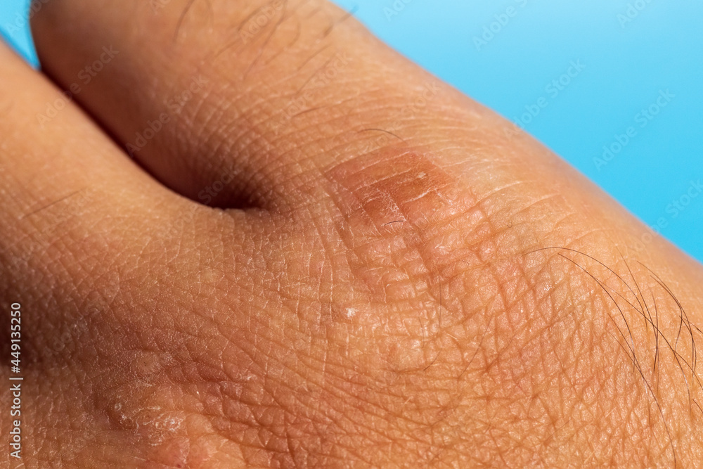 Fototapeta premium Extremely dry, dehydrated and cracked skin of a man hand with fragments of epidermis. Close-up selective focus