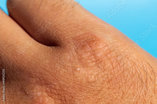 Extremely dry  dehydrated and cracked skin of a man hand with fragments of epidermis. Close-up selective focus