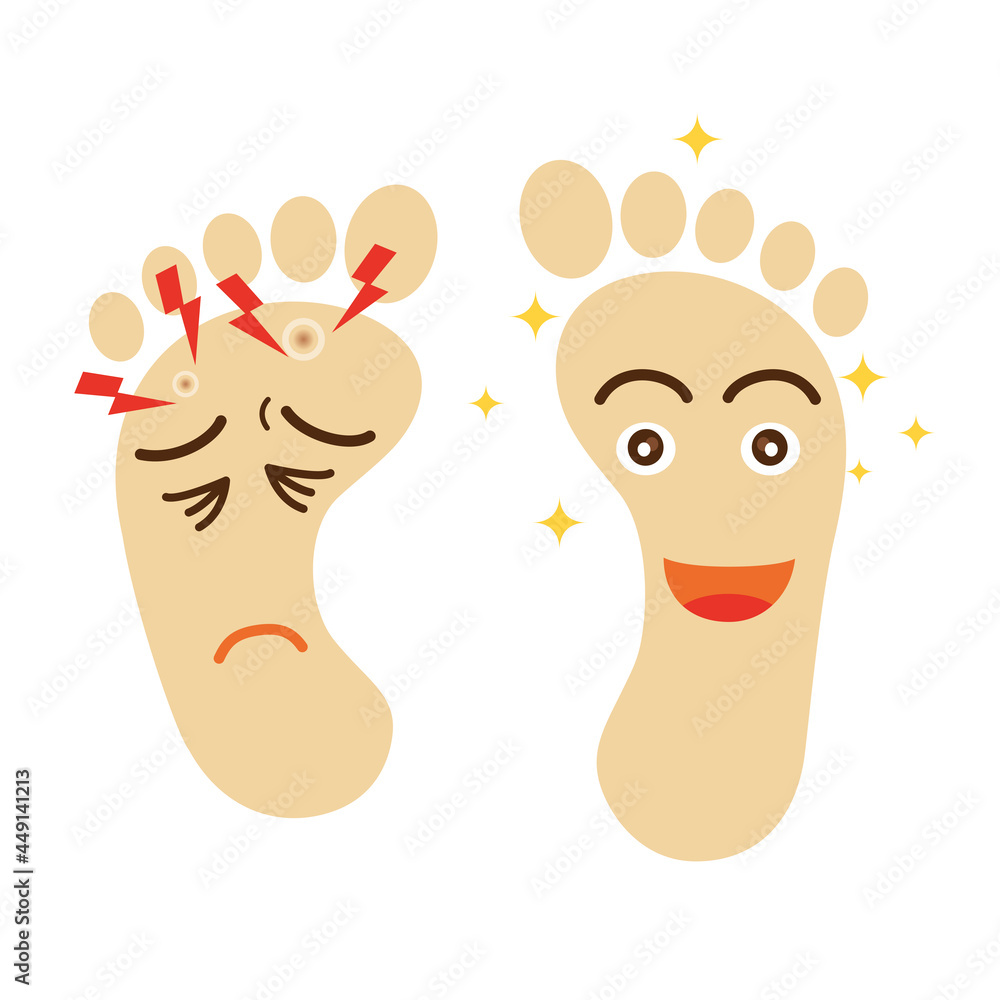 擬人化した魚の目の足と健康な足のイラスト 足跡足の裏のイラスト ボディパーツフットヘルス健康イメージfoot Corn Stock Vector Adobe Stock