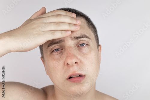 A man with sweating on his face is looking at the camera. Sweat gland problems. Hyperhidrosis, increased sweating, anhidrosis. The concept of treatment for violations of the mechanisms of secretion.