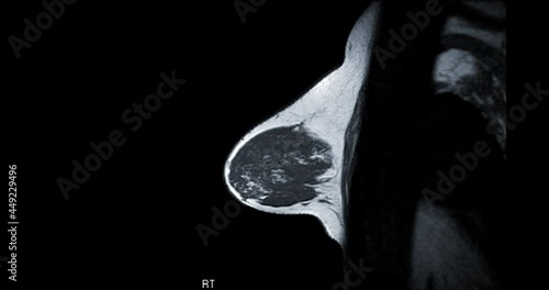 Breast MRI or magnetic resonance imaging sagittal T1W of Breast in women for screening breast cancer.  photo