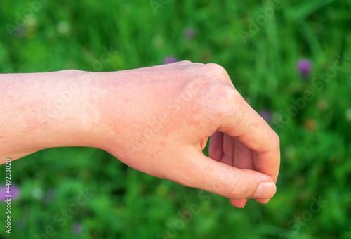 Red hot sun allergy spot on the arm is usually painful or itchy. Allergic skin disease.