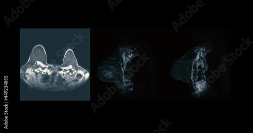 Compare of Breast MRI or magnetic resonance imaging Axial and Sagittal T2W of Breast in women for screening breast cancer.  photo