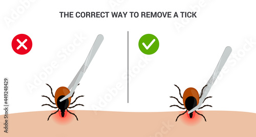 The correct way to remove a tick insect correctly. Tips for tick safety infographic photo