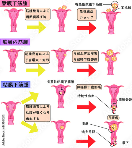 子宮筋腫