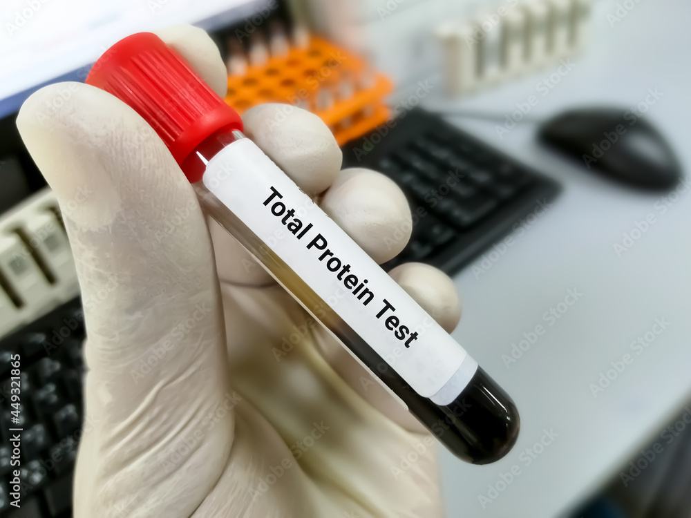 Technician hold blood sample for Total protein test Technician hold blood sample for Total protein test
