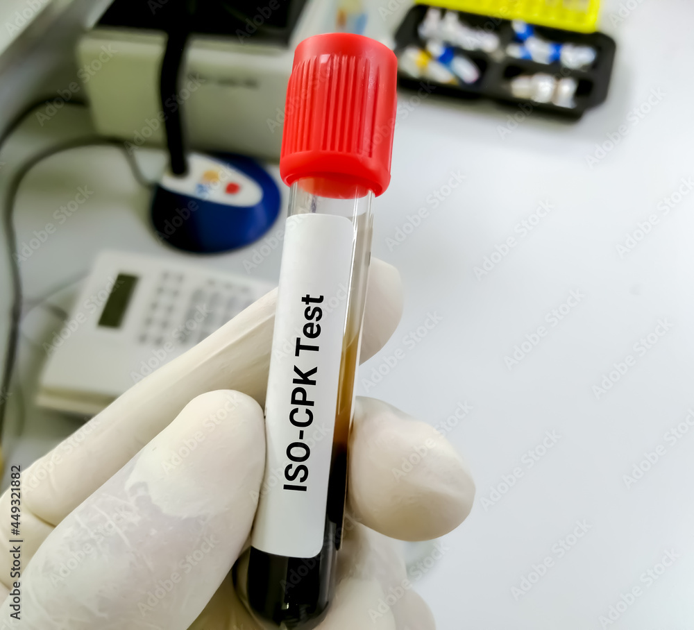 Blood sample for ISOCPK (isoenzyme of creatinine phosphokinase) enzyme