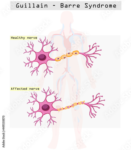 Covid 19 vaccine may have effect on Guillain-Barré syndrome (GBS). 