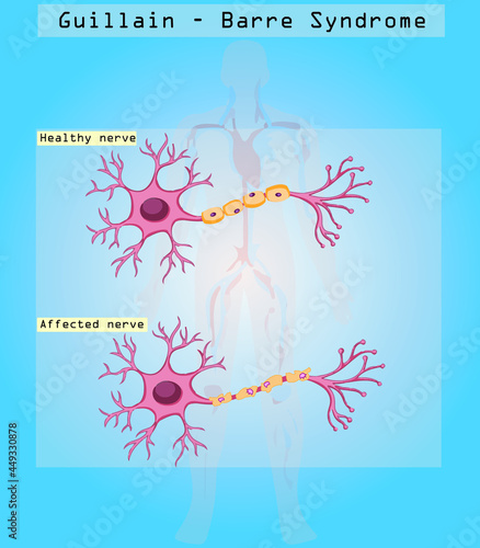 Covid 19 vaccine may have effect on Guillain-Barré syndrome (GBS). 