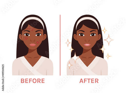 Beautiful Black Woman with Acne. Ugly.  Afro Lady with Problem Skin and Clean Face. A Teenage Girl with a Red Rash Before and After. Flat Cartoon Color Style. White background. Vector illustration.