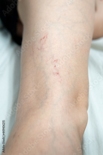 removal of blood vessels by laser vessel surgery, leg problem pressure health beauty, veins Help risk enlarged, tortuous telangiectases physical © Ilya