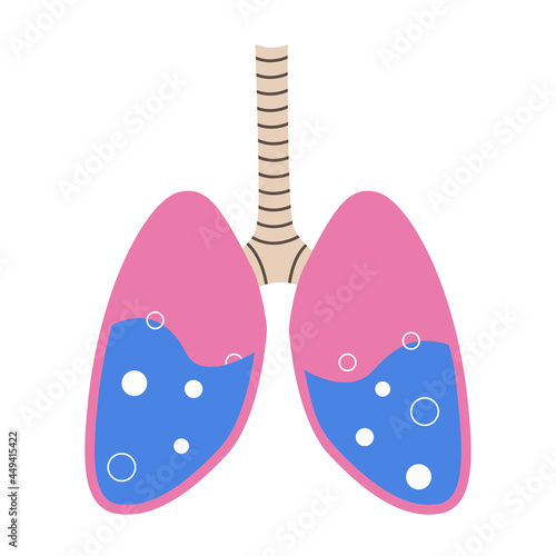 Pulmonary edema. Fluid in the respiratory organs. Bubbles in the lungs. Vector illustration.
