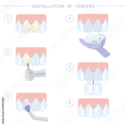 Dental treatment and care. Installation of veneers, stages of work. Instructions for dentists. Vector illustration for dentistry textbooks.