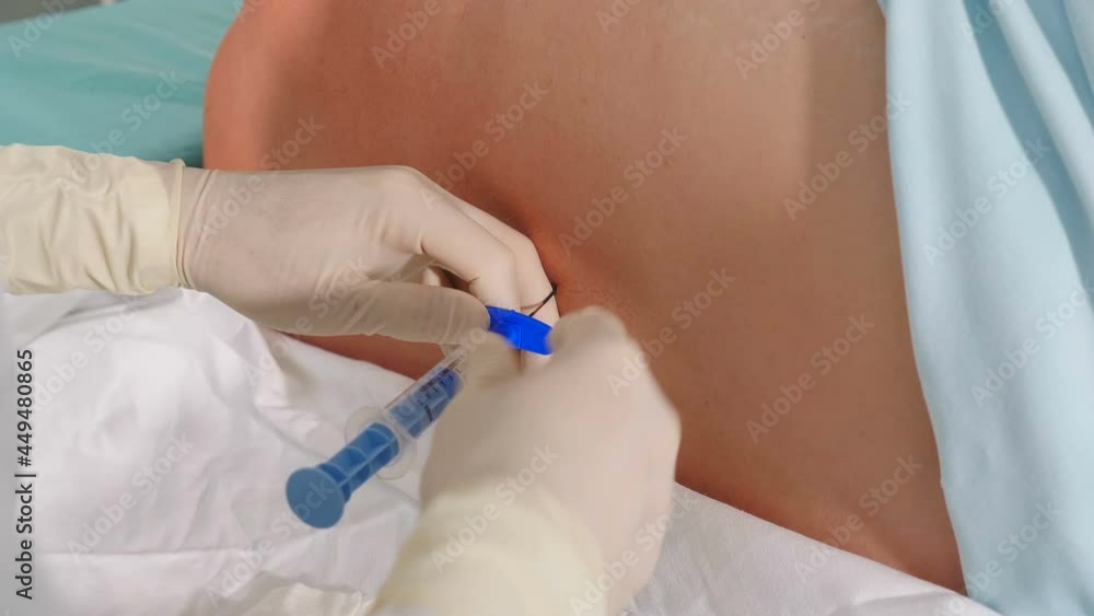 Spinal anesthesia injection, epidural anesthesia or nerve block. Anesthesiologist at work. Anesthesiologist or doctor holding epidural needle near patient back, Preparation for caesarean section or Spinal anesthesia injection, epidural anesthesia or nerve block. Anesthesiologist at work. Anesthesiologist or doctor holding epidural needle near patient back, Preparation for caesarean section or