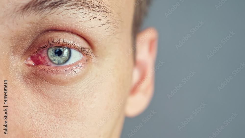 Αυτοκόλλητο Close up of the red eye of a man affected by an infection, copy space