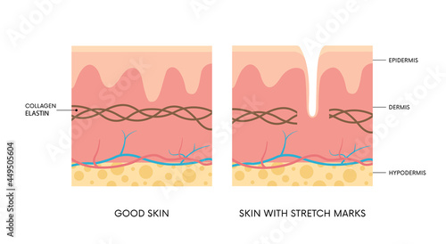 Anatomy of skin with and without stretch marks. Collagen, elastin, striae. Body positivity, beauty, skincare concepts