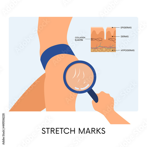 Female body with stretchmarks on hips and hand with magnifying glass and skin anatomy illustration. Striae on woman hips. Body positivity, beauty, skincare concepts photo
