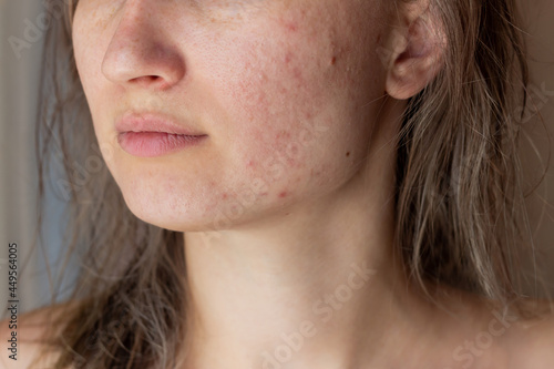 Cropped shot of a young woman's face with the problem of acne. Pimples, red scars on cheeks and chin. Allergies, dermatitis, rash. Problem skin, care and beauty concept. Dermatology, cosmetology photo