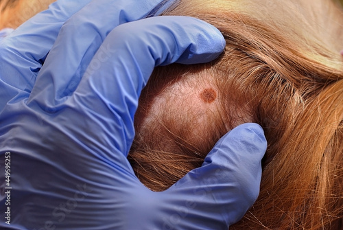 A gloved doctor examines a mole on the scalp. Close up.