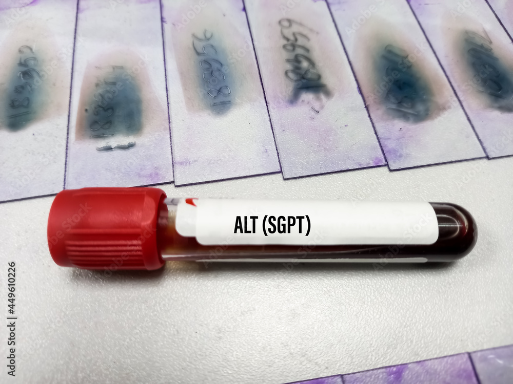 Blood sample for Serum ALT (SGPT) test, liver function test Stock Photo ...