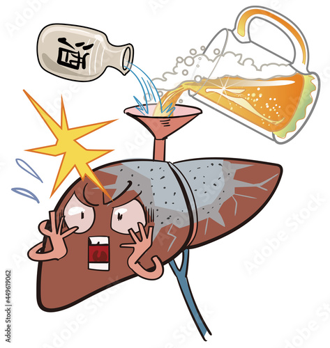 肝硬変-アルコールの摂り過ぎで肝臓が固まる病気