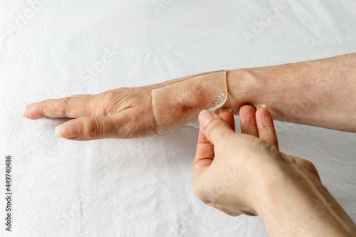 Applying a special medical self adhesive silicone gel sheet  to a healing scar after tendon surgery on a woman's hand.