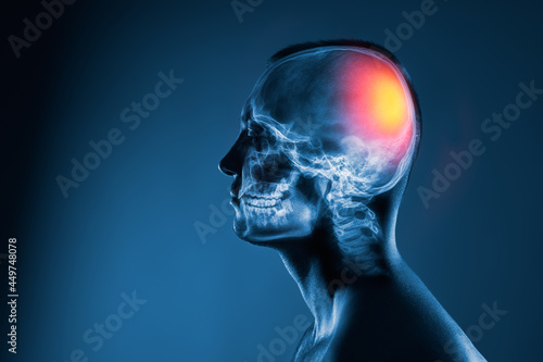 X-ray of a man's head on blue background. Medical examination of head injuries. Cerebral stroke. The back of the brain is highlighted yellow red colour. Others x-ray images in my portfolio.