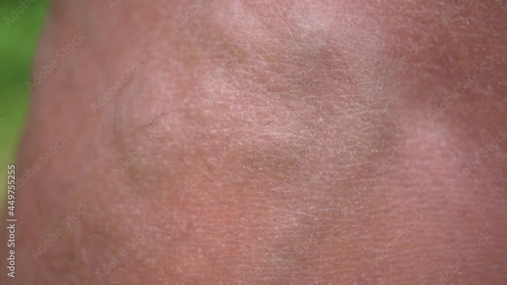 Varicose veins can be seen under the skin on the leg men macro. Varicose veins can be seen under the skin on the leg men macro.
