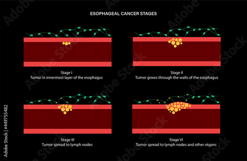 esophageal cancer stages