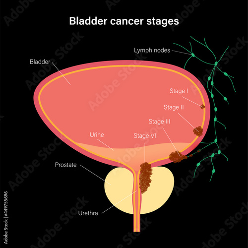 Bladder cancer stages