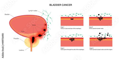 Bladder cancer stages