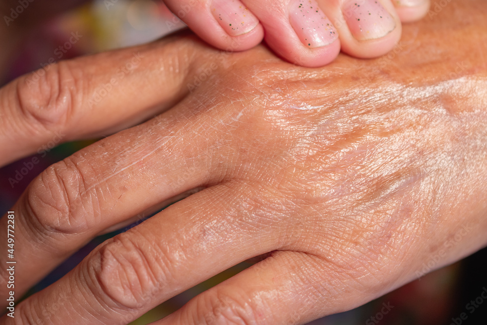 The woman has pain in the joints of her hands. Sick brush. The woman has pain in the joints of her hands. Sick brush.