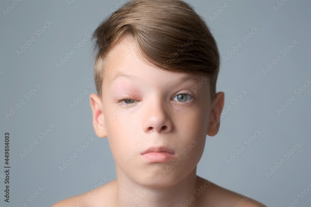 Portrait of a boy with a swollen eye from an insect bite. Allergic reaction to insect bites