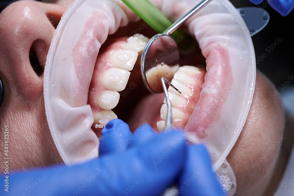 Close up of orthodontist checking woman teeth with dental mirror and