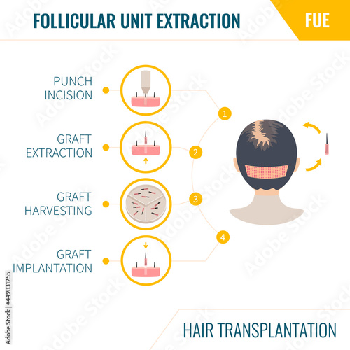 FUE hair transplantation infographics. Female alopecia treatment method. Follicular unit extraction surgery steps. Woman with balding head in rear view. Medical vector illustration.