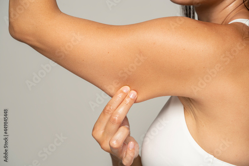 a woman pinches and shows the fat on her hands