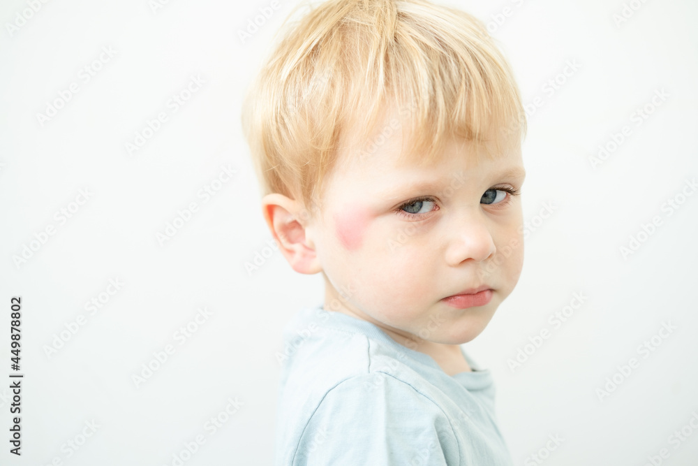 portrait of little Boy with allergic red spot at face cause by mosquito bite portrait of little Boy with allergic red spot at face cause by mosquito bite