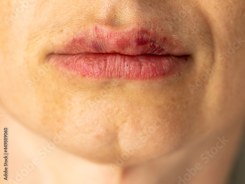 Beautiful middle aged woman with a bruise on her lips after lip augmentation with hyaluronic acid. Injection cosmetology concept. Front view, horizontal