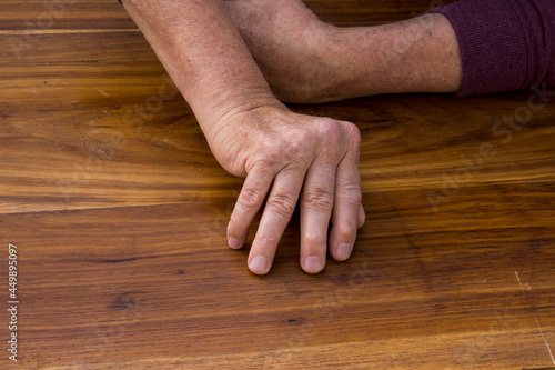 The hands of a male with Psoriatic Arthritis showing deviation of the Ulnar metacarpal joints. photo