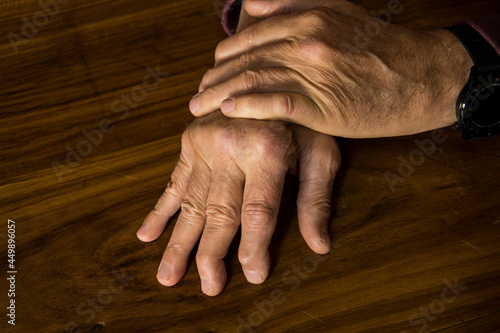 Canvastavla The hands of a male with Psoriatic Arthritis showing deviation of the Ulnar metacarpal joints