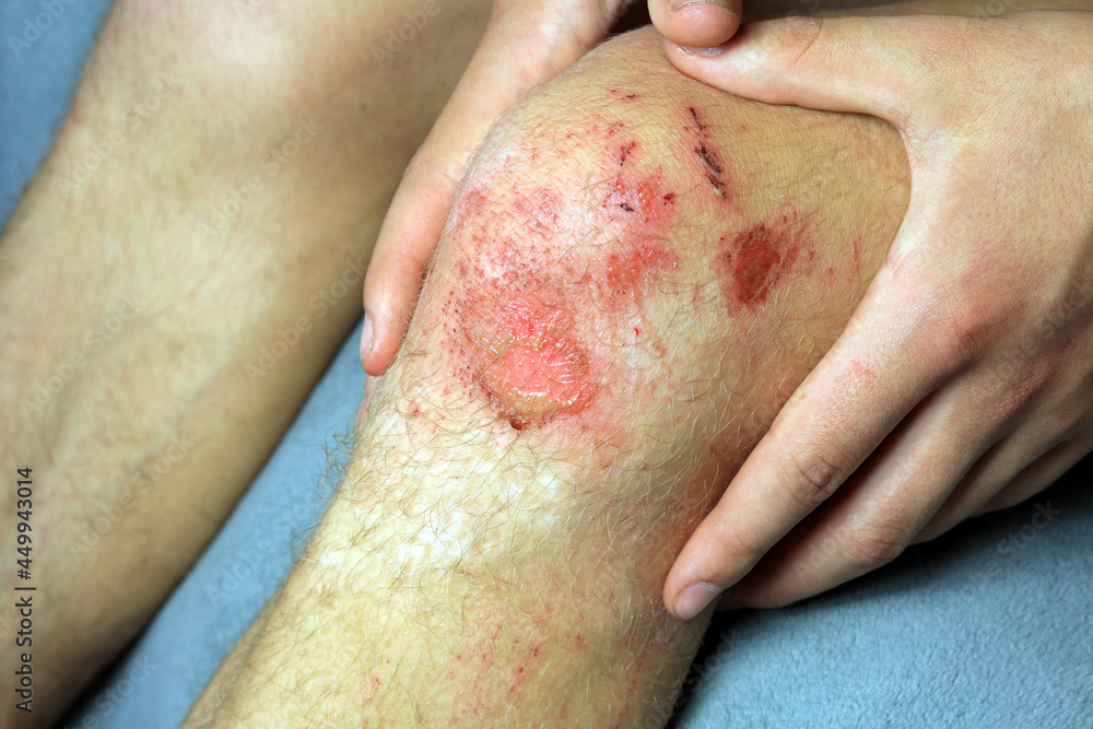 A Grazed Injury On A Knee. Photos | Adobe Stock
