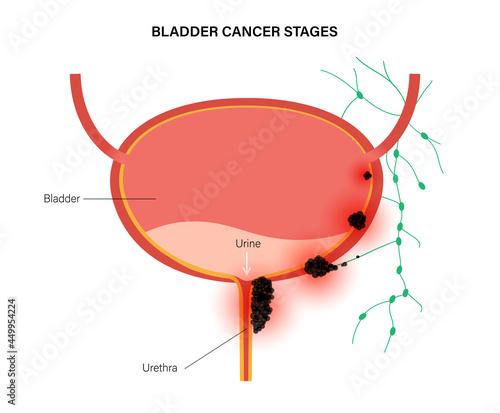 Bladder cancer stages