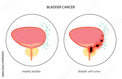 Bladder cancer stages