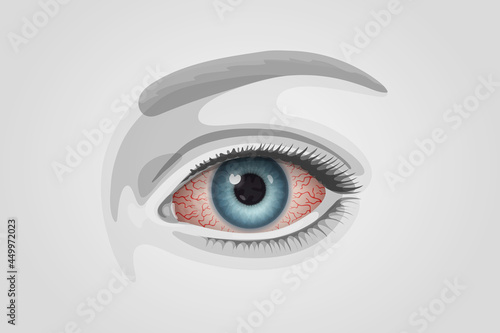 Reddened human eye with many distinct blood vessels
