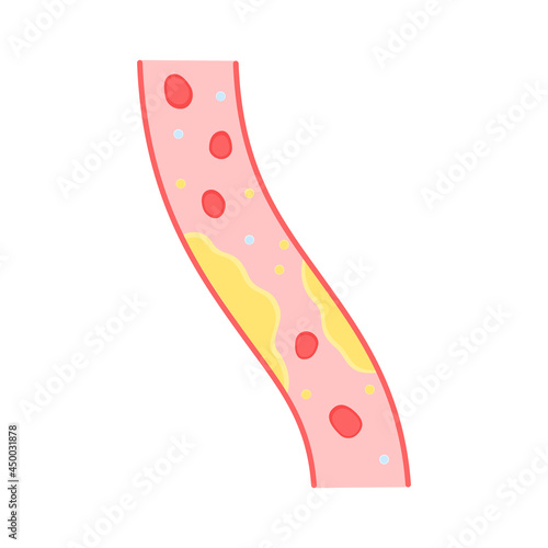 color blood vessel with cholesterol