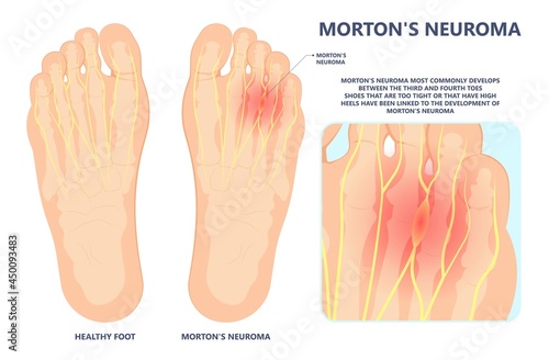 Fotografie, Tablou Morton's neuroma pain foot ball toe shoe tissue nerve High heel tight lump injur