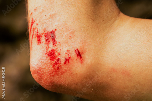 Fresh bleeding wound caused by falling on a hard rocks in a mountain