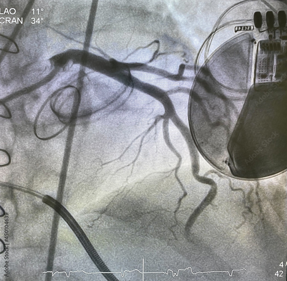 X ray image perform prosthetic heart valve, staples, steel suture and